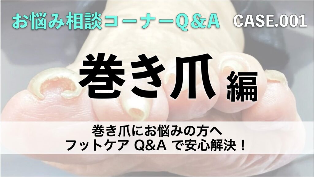 巻き爪にお悩みの方へ|フットケア Q&A で安心解決！