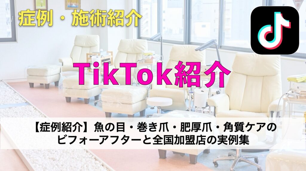 TikTokで急上昇中！ドクターネイル爪革命のフットケア動画｜巻き爪・魚の目の専門施術をチェック