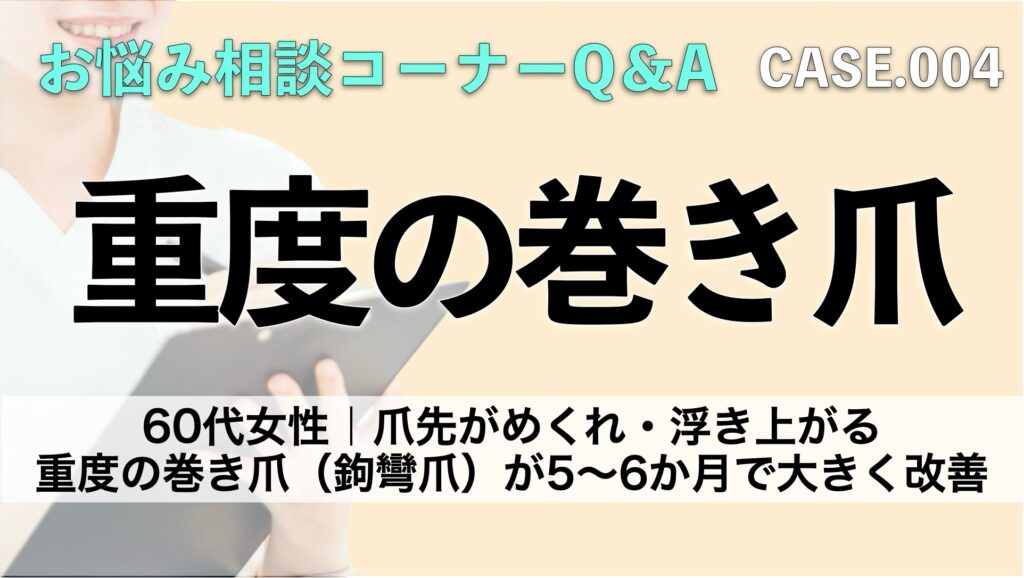 60代女性|爪先がめくれ・浮き上がる重度の巻き爪(鉤彎爪)が5〜6か月で大きく改善